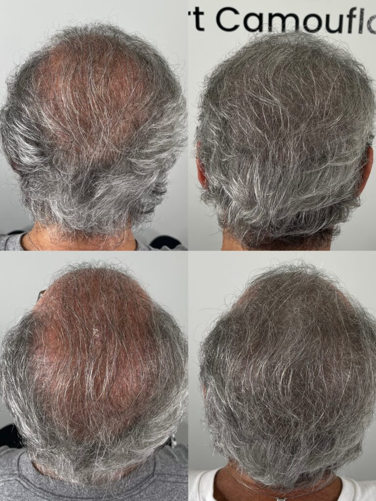 Before and after scalp micropigmentation in Boca Raton for gray hair and crown thinning