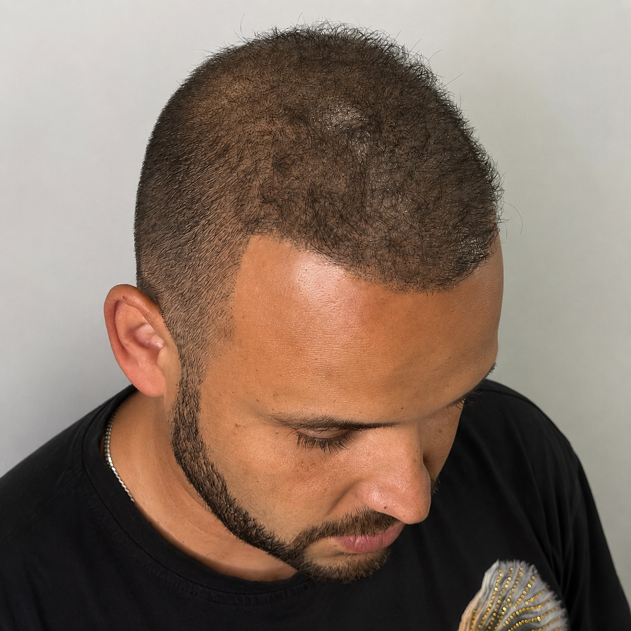 Natural male hairline after scalp micropigmentation in Boca Raton
